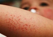 Activaron protocolo por sospecha de sarampión en Nogoyá